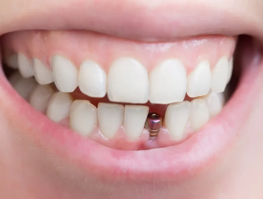 Dental Implants in Abu Dhabi