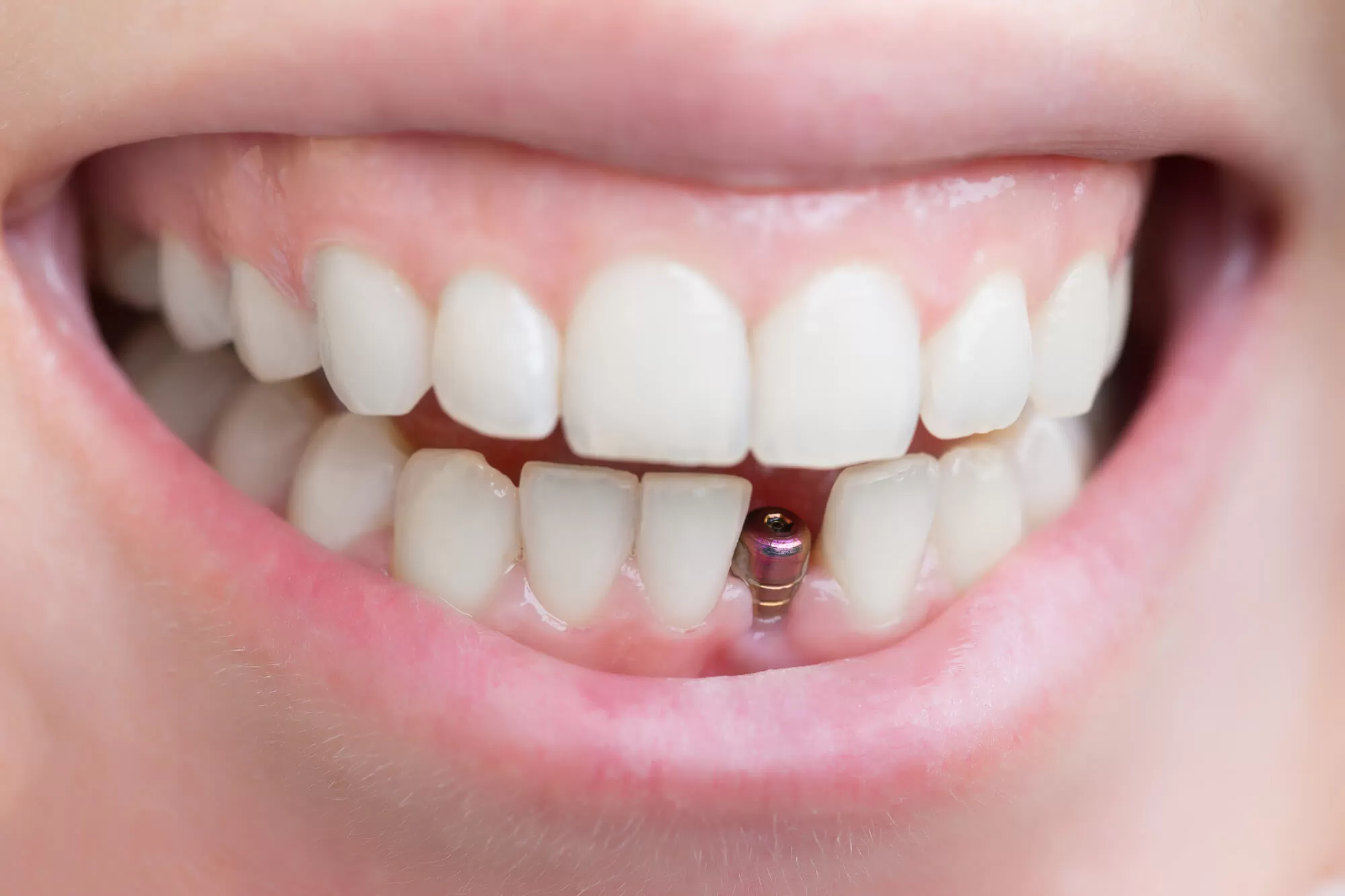 Dental Implants in Abu Dhabi