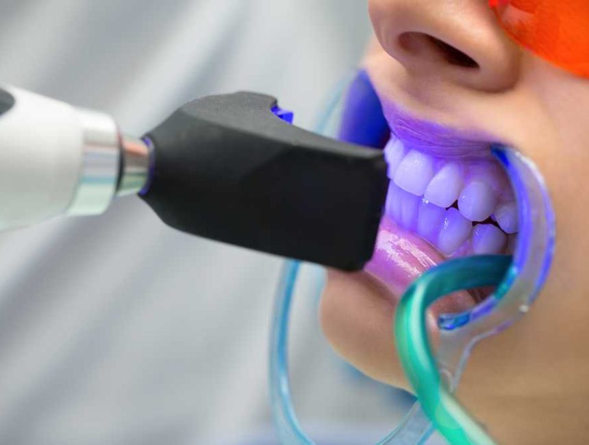 NANO TEETH WHITENING TREATMENT –VISION DENTAL CLINIC COSMETIC DENTIST EXPLORES THE BENEFITS