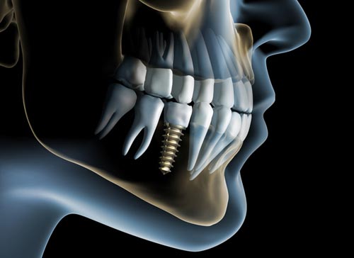 dental implant abu dhabi 3d image