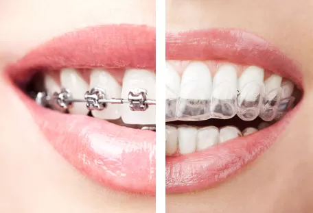 What Types of Orthodontic Treatment Best for You