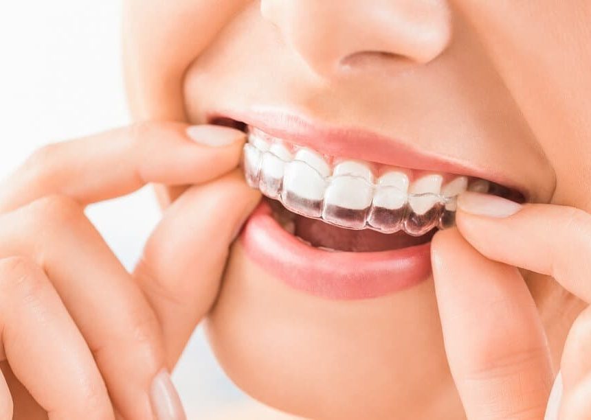 Why Invisalign is the most Suggested Aligners?