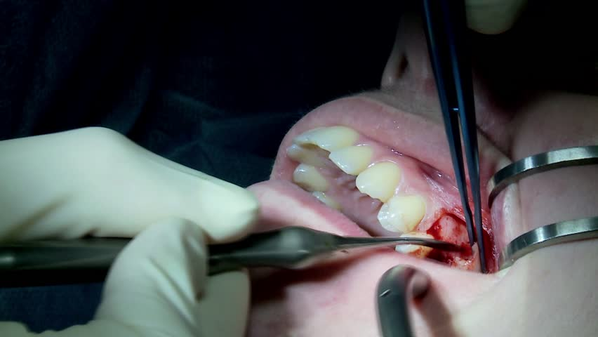 tooth removal in abu dhabi