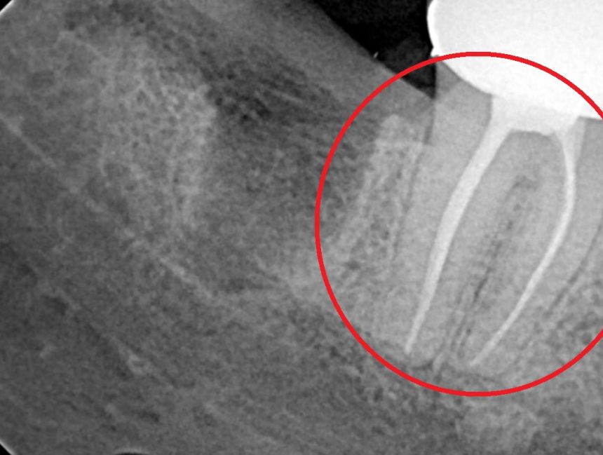 Wisdom Teeth – Why It needs to be Removed?