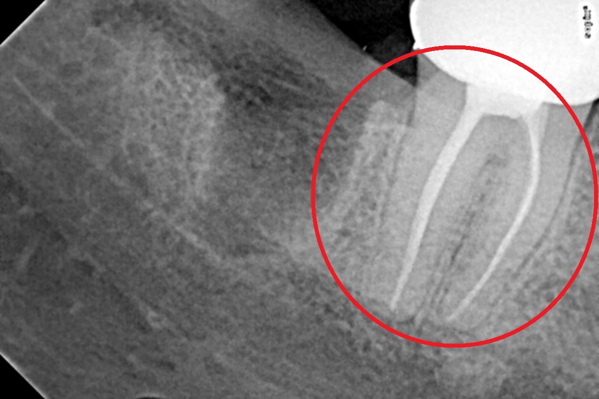 Wisdom Teeth – Why It needs to be Removed?