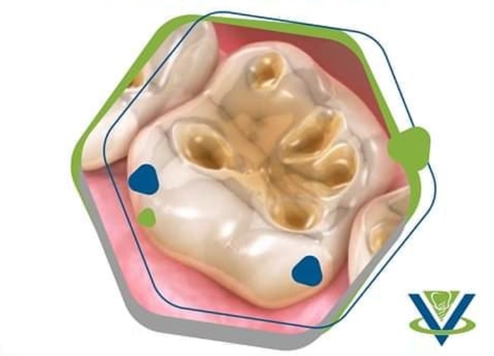 dental erosion prevention