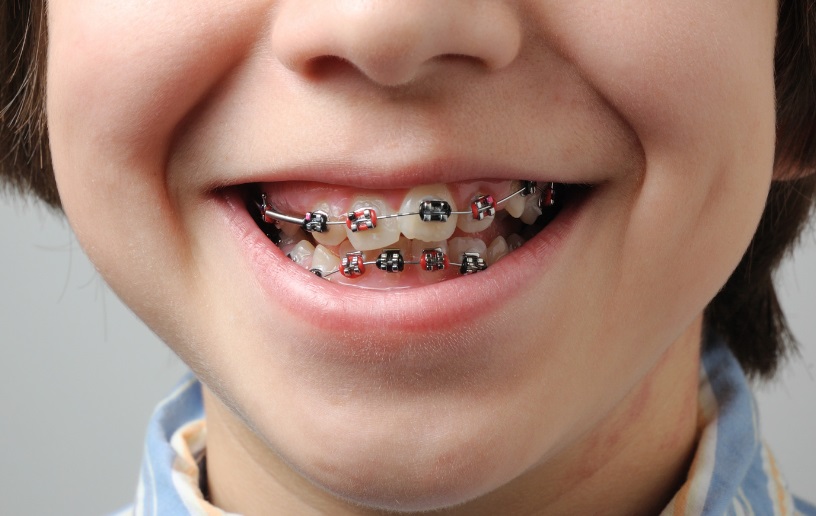 the danger of diy dental braces