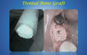 dental bone graft in abu dhabi