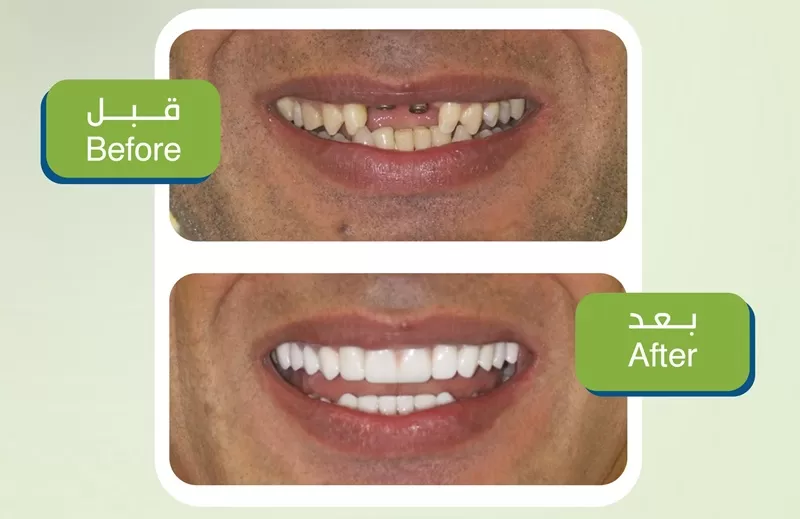 Why Replacing Lost Tooth Is Important