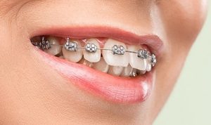 dental braces in abu dhabi