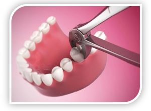 tooth extraction in abu dhabi