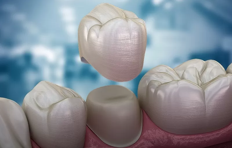 Understanding Inlay, Onlay, Crown, and Endocrown Restorations