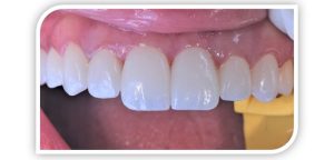 veneers and crowns in abu dhabi