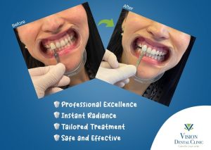 teeth whitening in abu dhabi