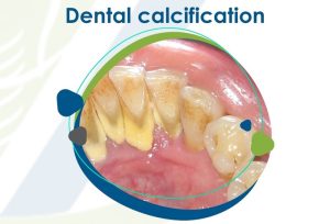 Dental Calcification