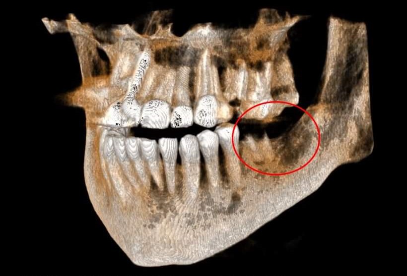 cbct 3d in dental