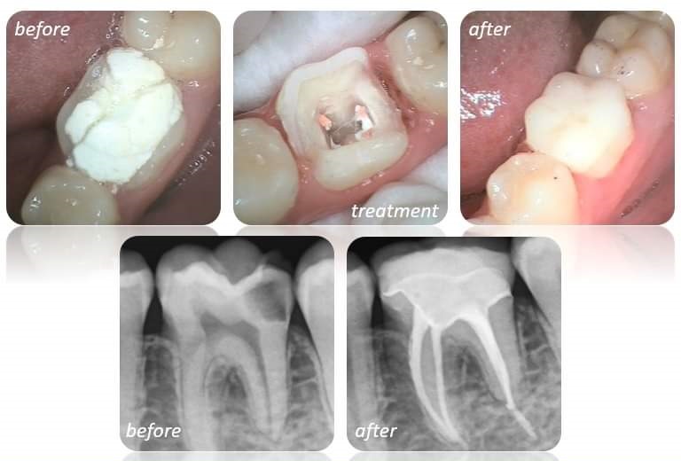 rct endocrown