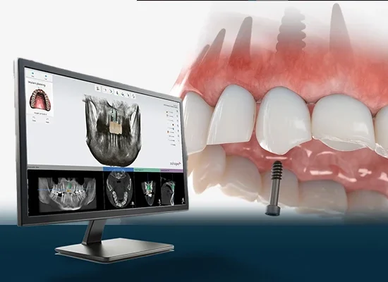 Dental Implants