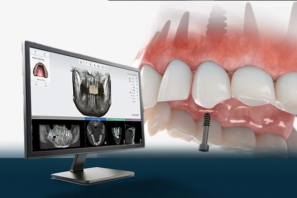 Dental Implants