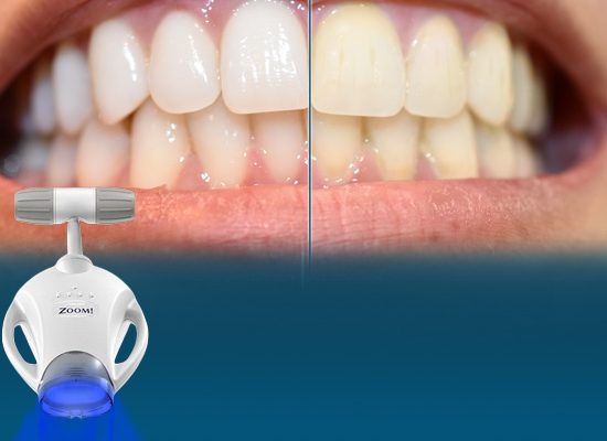 Teeth Whitening