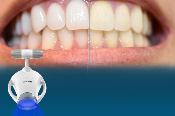 Teeth Whitening